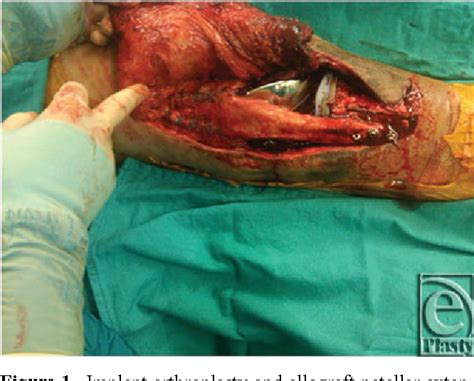 Figure 1 From CASE REPORT Simultaneous Latissimus Dorsi Myocutaneous