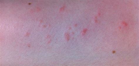 Natural Remedies For Red Bumps On Arms Bumps On Arms Keratosis