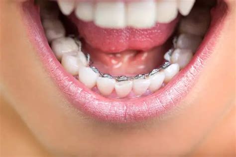 How Much Do Braces Cost In Colorado