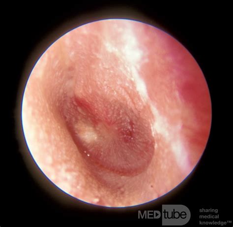 Pinhole Perforation From Acute Otitis Media Picture