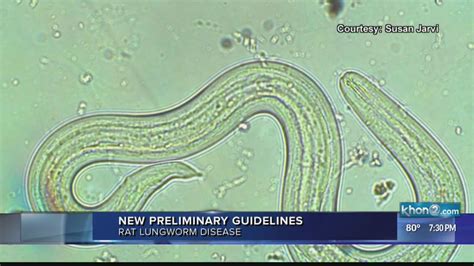 Doctors Receive New Guidelines To Diagnose Treat Rat Lungworm Disease