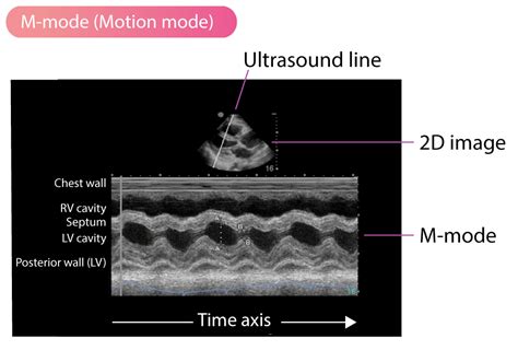 M Mode Motion Mode Echocardiography Ecg And Echo
