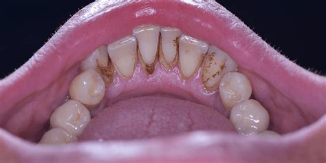reasons for a coffee stain on teeth to appear and how to solve themdental clinic dentists in
