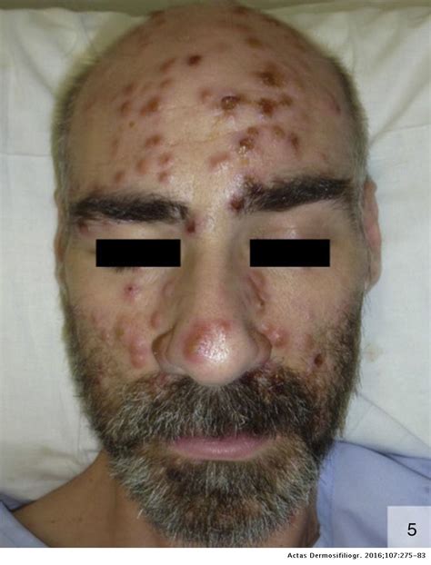 Atypical Cutaneous Manifestations In Syphilis Actas Dermo Sifiliográficas