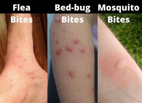 Are Bed Bug Bites On The Body Temporary