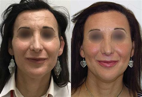 Facial Feminization Surgery Before And After Facifem Dr Macía Patients