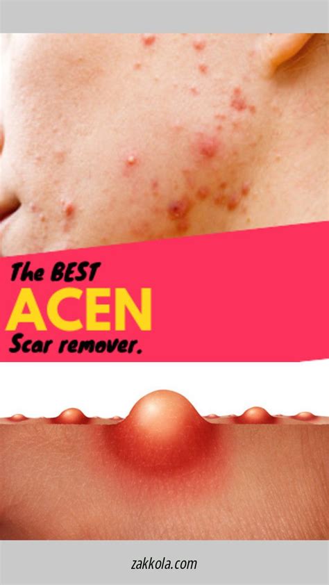 Read Information On Acne Check The Webpage For More Info Acne