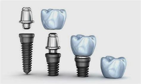 Implantes Dentales Tipos Y Clasificación Clínica Dental Navarro
