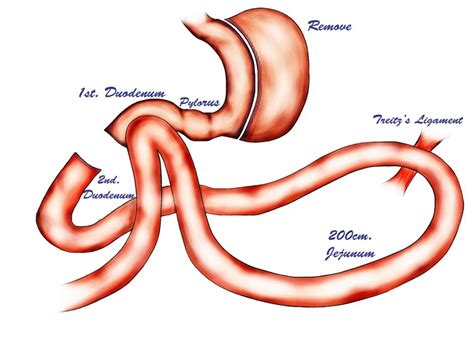 Loop Duodenojejunal Bypass With Sleeve Gastrectomy Dr Amit Garg