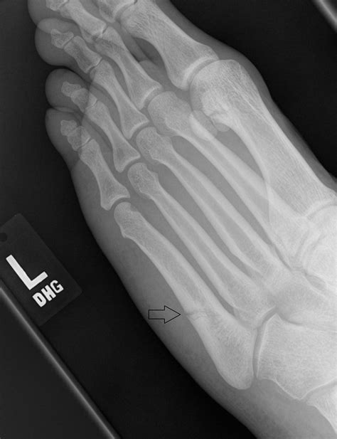 Oblique View Of The Foot Demonstrating An Incomplete Jones Fracture Download Scientific Diagram