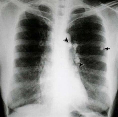 Raio X Na Tuberculose Como Identificar Achados Suspeitos Medway