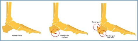 Calcaneal Osteotomy Heel Bone Spur Yellowstone Surgery Center