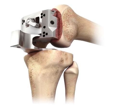 Depuy Attune Knee Replacements Tibial Loosening