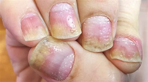 Łuszczyca paznokci objawy oraz sposoby leczenia To musisz wiedzieć