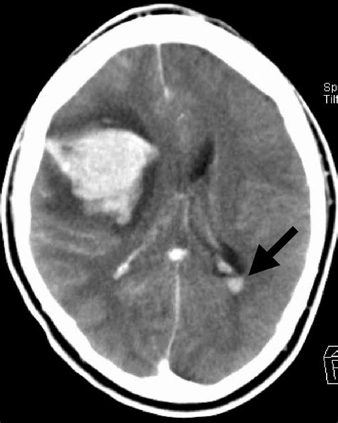 Post Intravenous Contrast Ct Brain Scan Demonstrating Right Cerebral