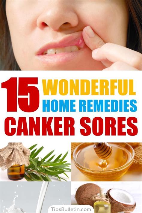 15 Canker Sore Relief Remedies That Work Canker Sore On Gum Sore In