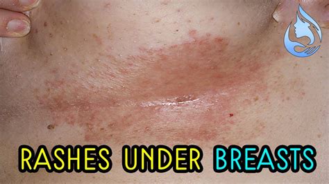 home remedies to treat the rashes under the breasts youtube