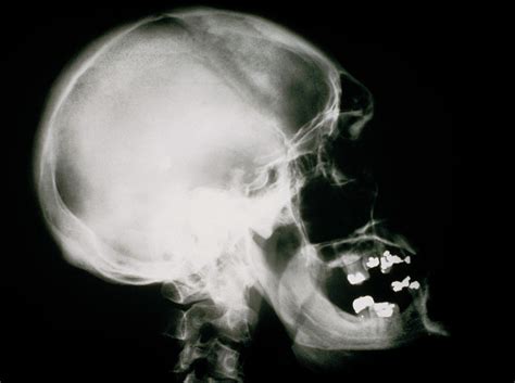 X Ray Of Human Skull Showing Acromegaly Photograph By Science Photo