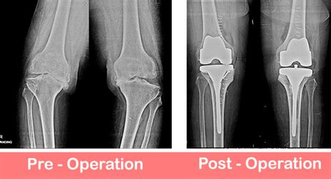 Bilateral Total Knee Replacement Sant Parmanand Hospital