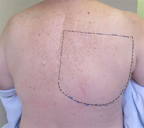 A Case Report Of Refractory Notalgia Paresthetica Treated With