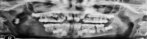 Conservative Management Of Odontogenic Keratocyst In A Terti