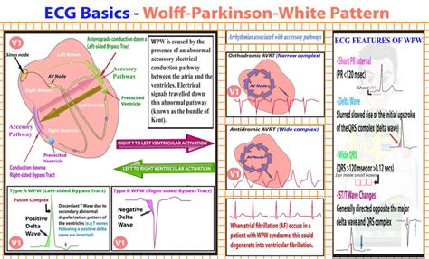 Wolff Parkinson White Syndrome Causes Symptoms Treatment