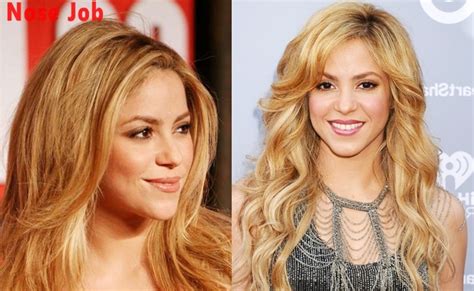 Shakira Nose Job Plastic Surgery Before And After