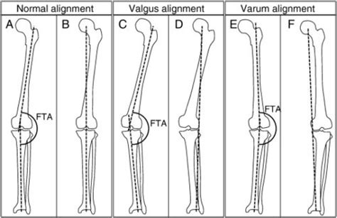 Cosm High Tibial Osteotomy With Or Without Acl Reconstruction