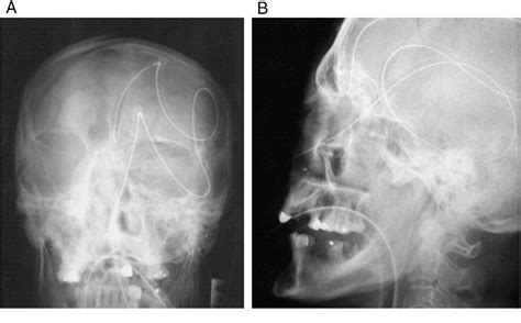 Accidental Pneumothorax From A Nasogastric Tube In A Vrogue Co