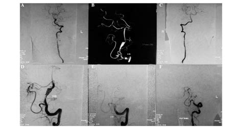 A Digital Subtraction Angiography Dsa And B 3d Dsa Images Showing