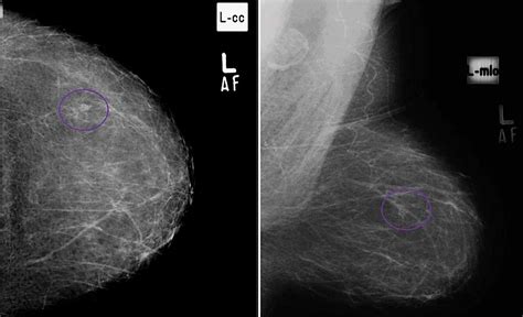 Cureus Mammographic Criteria For Determining The Diagnostic Accuracy Of Microcalcifications In