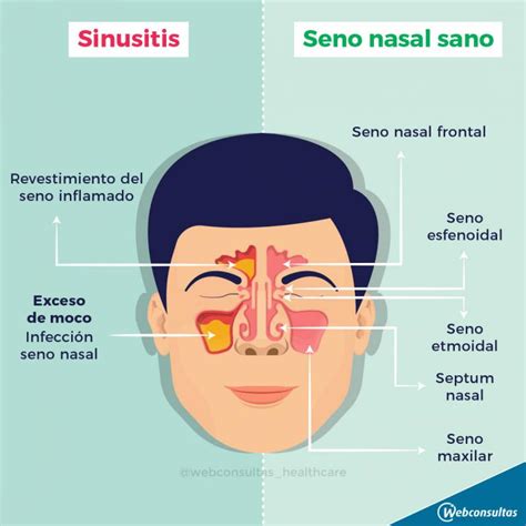 Sinusitis Qué Es Y Cómo Te Puede Afectar Salud Al Día