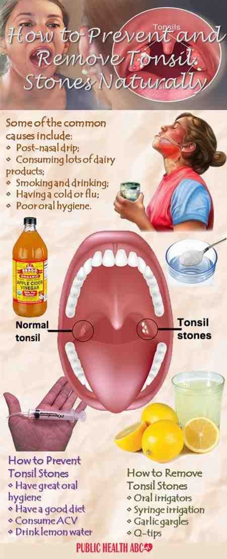Sore Throat Soothers Tonsillitis Recurrent Prevent How Duoalbarus