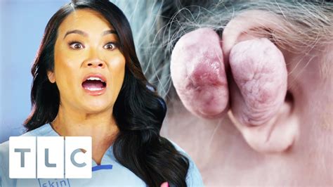 dr lee removes 14 oz keloid from woman s ear dr pimple popper youtube