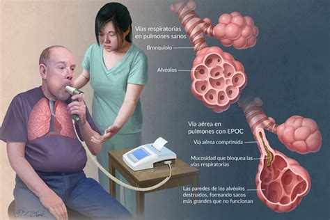 Enfermedad Pulmonar Obstructiva Crónica EPOC