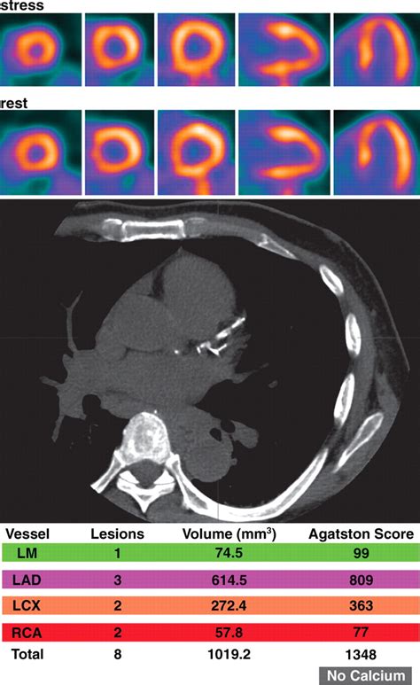 Cardiac Petct For The Evaluation Of Known Or Suspected Coronary Artery