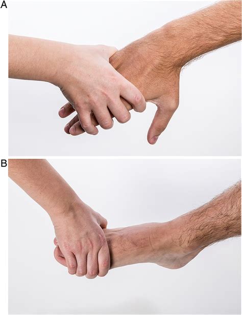 The Diagnostic Accuracy Of The Squeeze Test To Identify Arthritis A