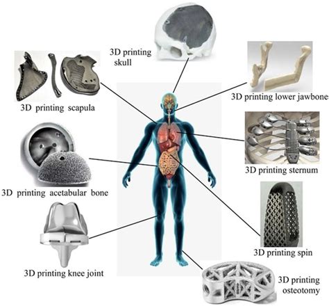 An Overview Of 3d Printed Metal Implants Think3d