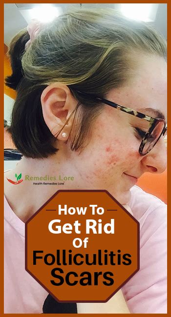 How To Get Rid Of Folliculitis Scars Remedies Lore