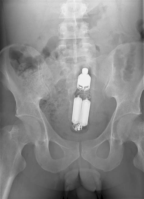 Sex Toy In Mans Rectum X Ray Photograph By Du Cane
