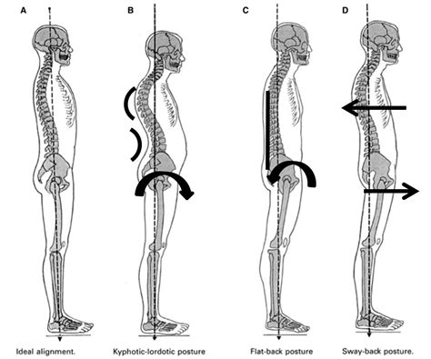 Posture Types How To Improve Posture Your Pilates Physio