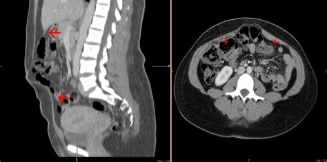Ct Scan Abdomen Showing Hernia With Divarication Arrows Shows