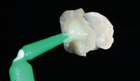 Clinical Case Restoration Of A Molars Occlusal Surface Using The