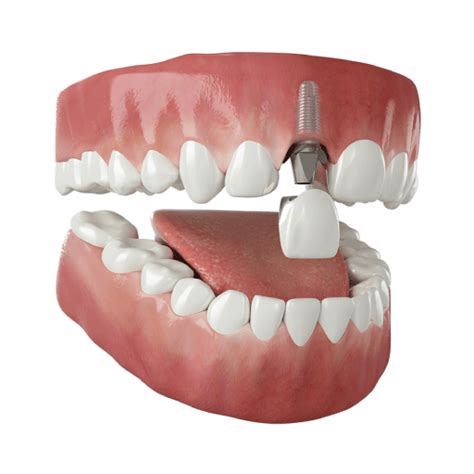 Implantes Dentales y Coronas Sonría