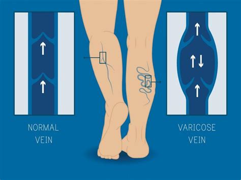 Varicose Veins Treatment Options In Tomball Heart And Vascular Center Of