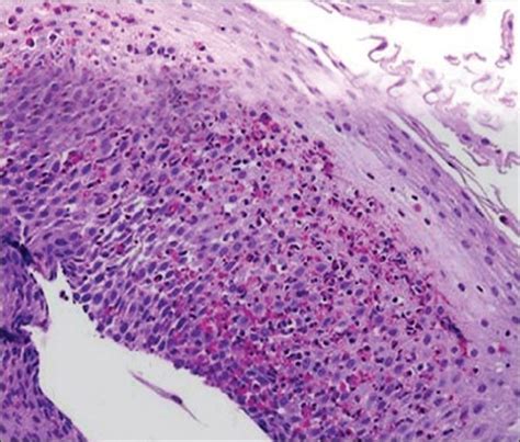 Histologic Findings Showing Infiltration With Eosinophils And