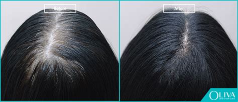 Female Pattern Baldness Signs Causes And Treatments
