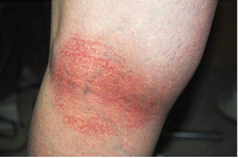 Patients Presenting With Miliaria While Wearing Flame Resistant