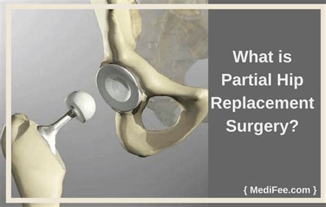 Partial Hip Replacement Surgery Methods Risks And Precautions