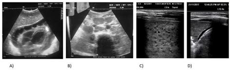 Focused Ultrasound To Diagnose Hiv Associated Tuberculosis Fash In